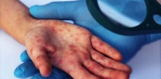 measles 4